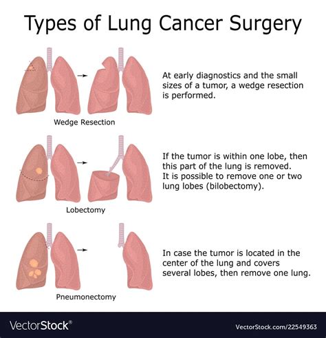 With that said, lung cancer is very treatable if caught early. . At what size should a lung nodule be removed